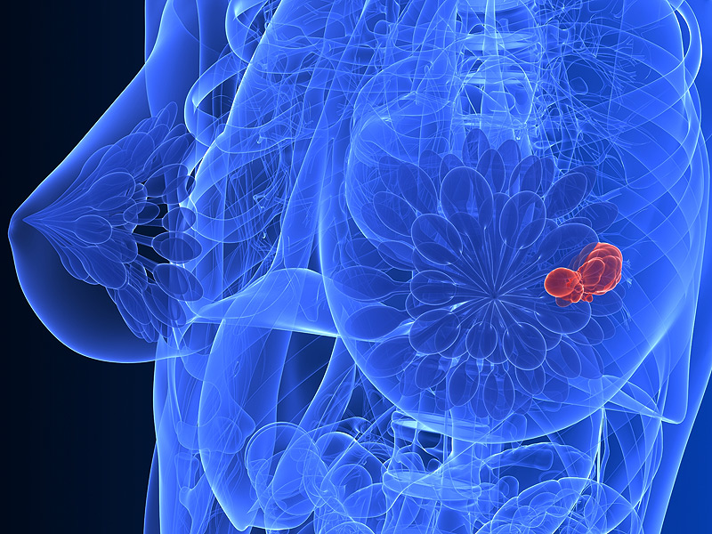 dt_150728_breast_cancer_tumor_800x600