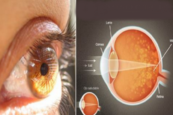 saffron macular degeneration