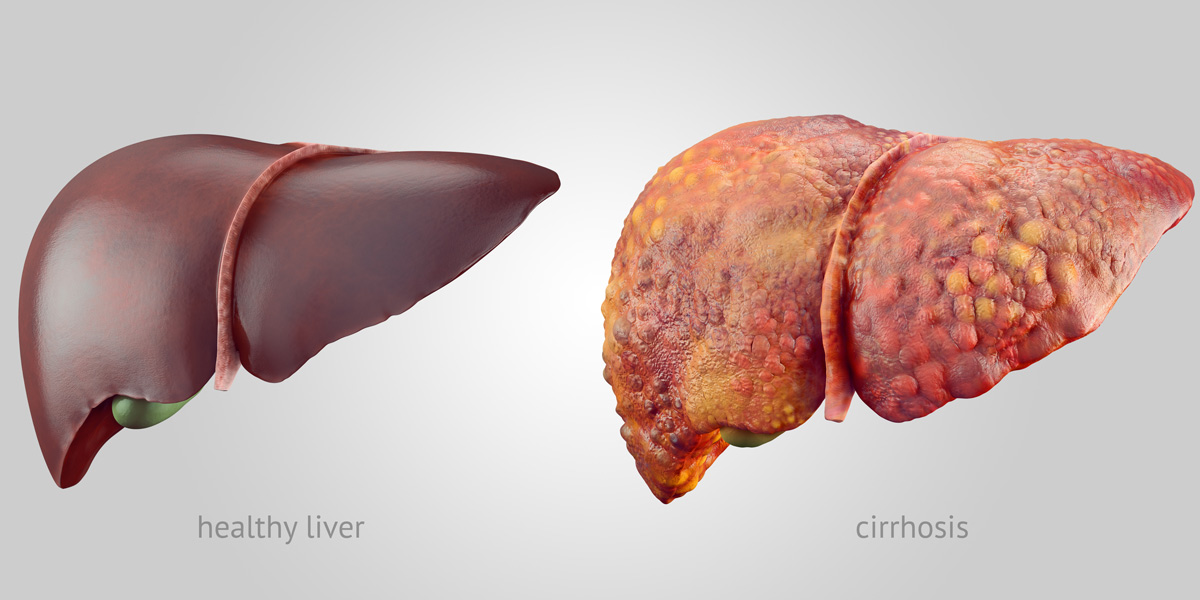 Study Shows Roundup Weedkiller Causes Liver Disease at Extremely Low Concentrations