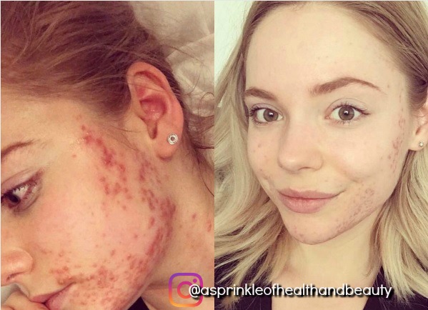 cystic acne diet before and after cystic acne diet before and after