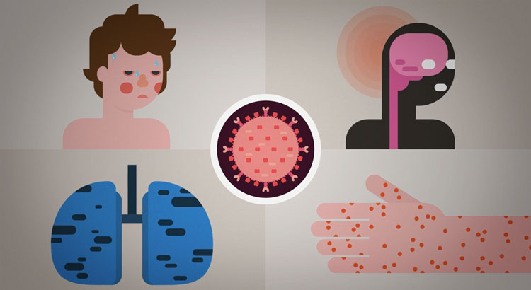 measles2