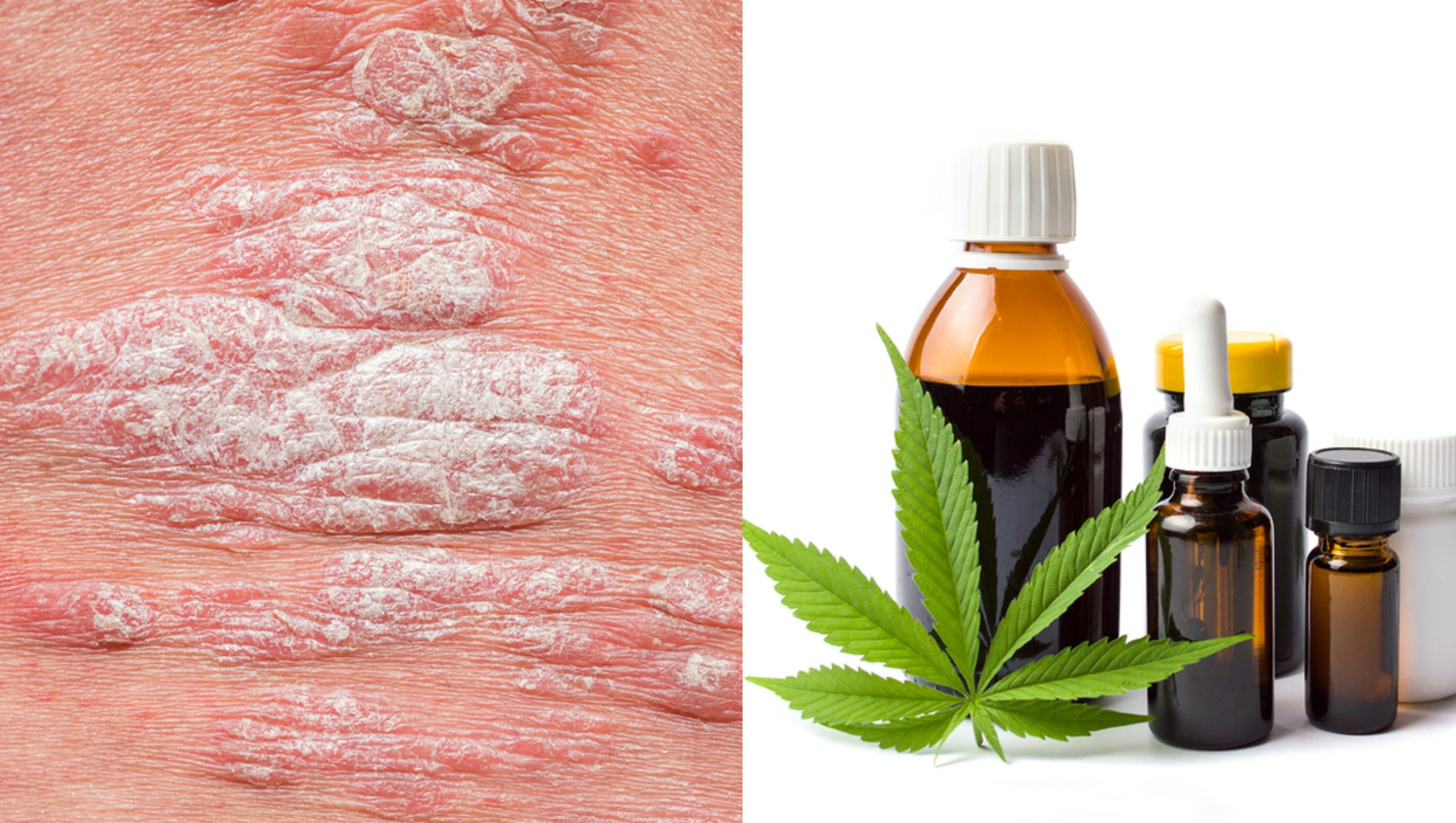 cbd psoriasis cure