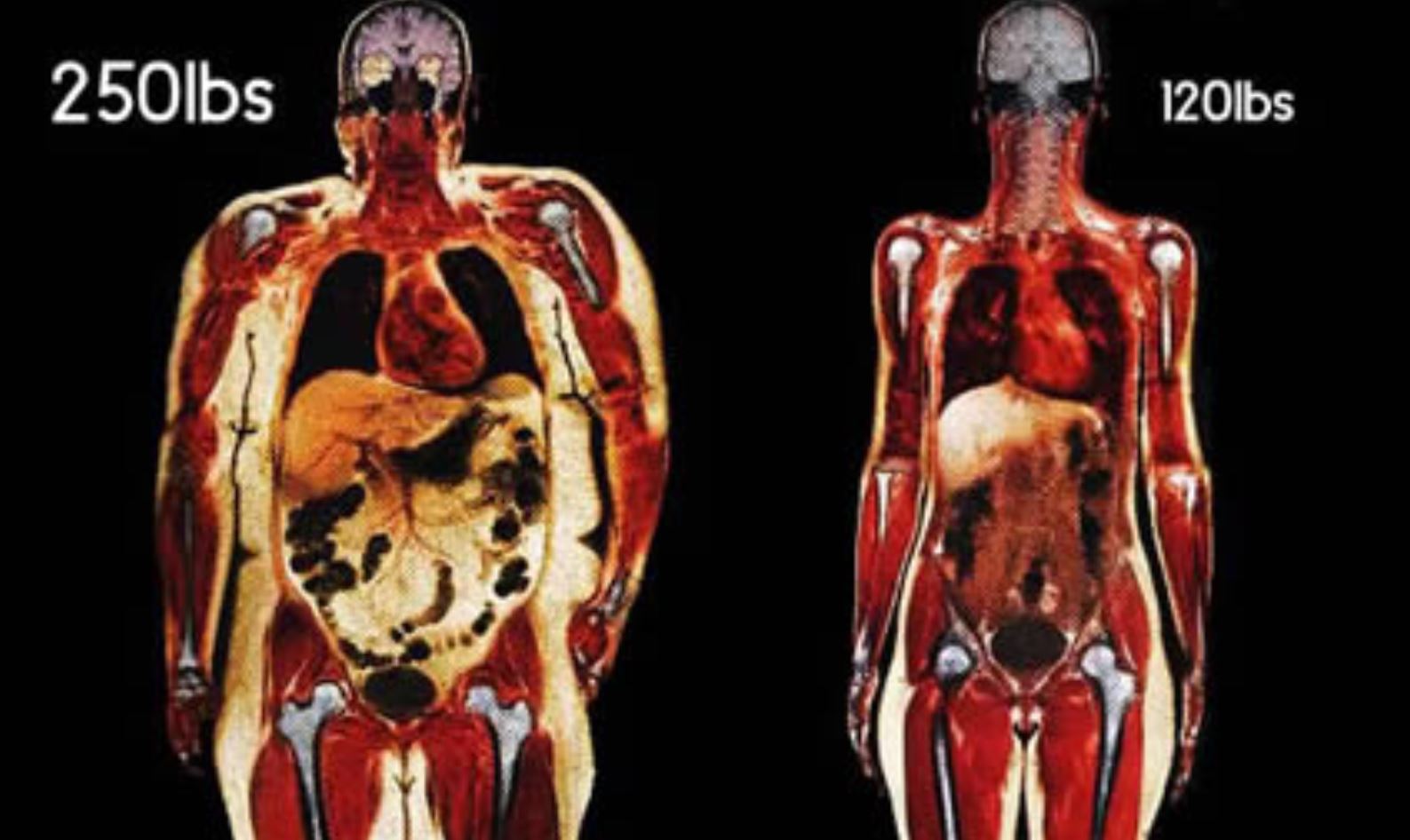 obesity abdominal