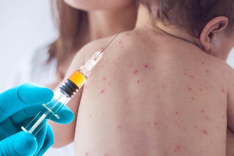 Measles-Vaccine-Kid Measles-Vaccine-Kid