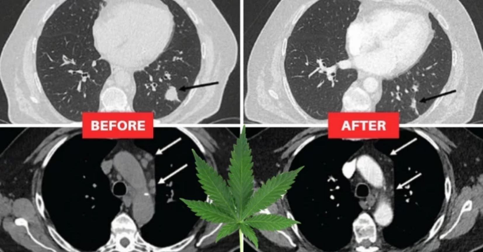 lung tumors cbd oil lung tumors cbd oil