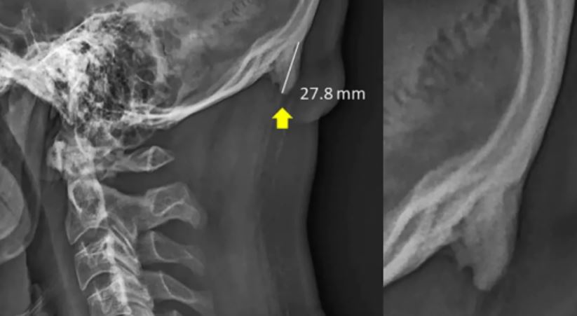 bone spur