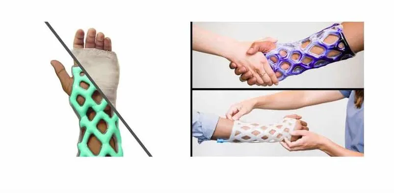 Engineers-Create-A-Breathable-And-Waterproof-Cast-To-Replace-Plaster-Ones Engineers-Create-A-Breathable-And-Waterproof-Cast-To-Replace-Plaster-Ones