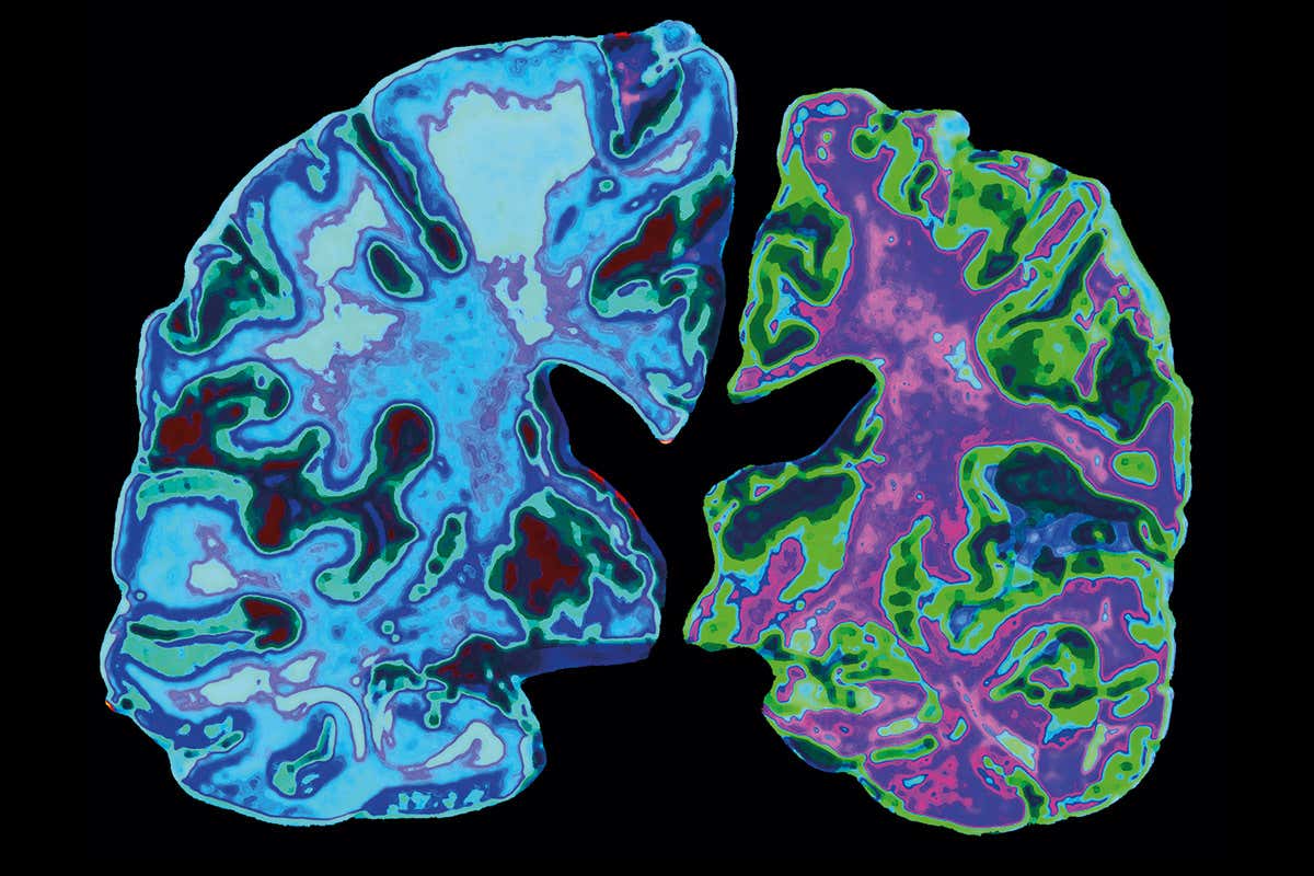 brain-1