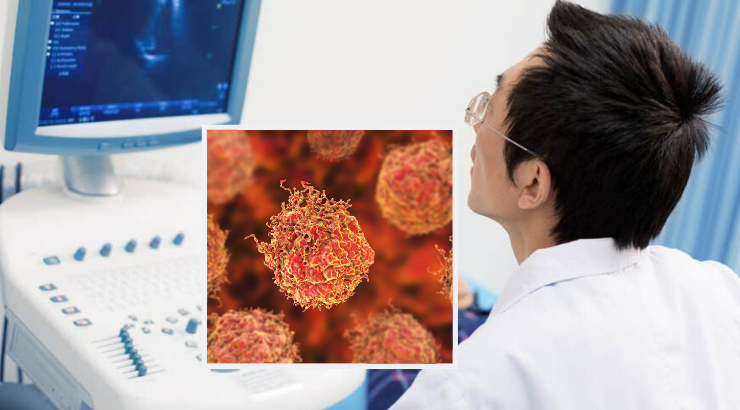 prostate-cancer-treatment-ultrasound-eliminates-tumors
