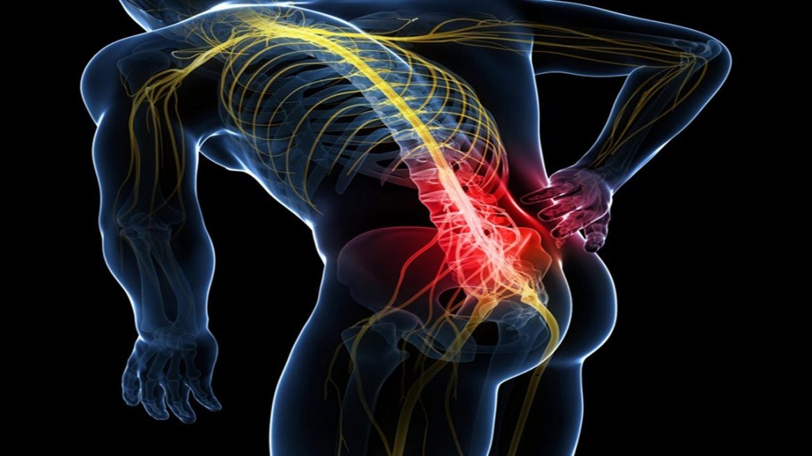 sciatica-3-1170x658