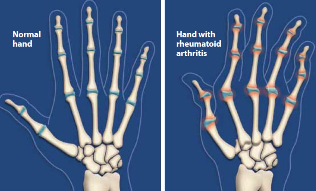 arthritis ce