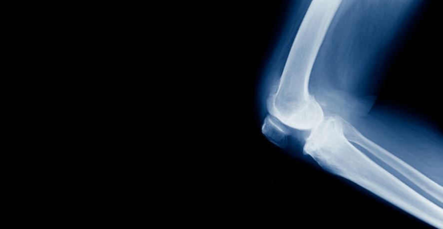 fracture gmi