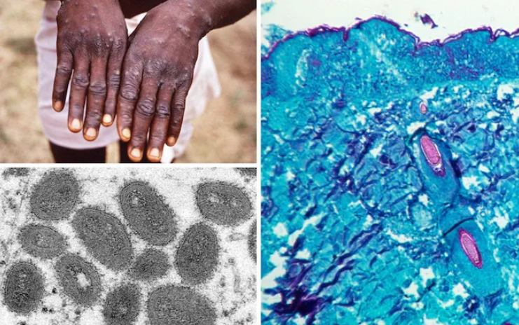 monkeypox monkeypox
