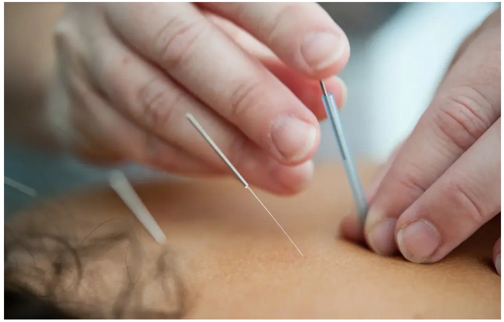 acupuncture unsplash