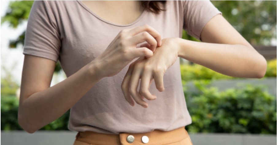 eczema