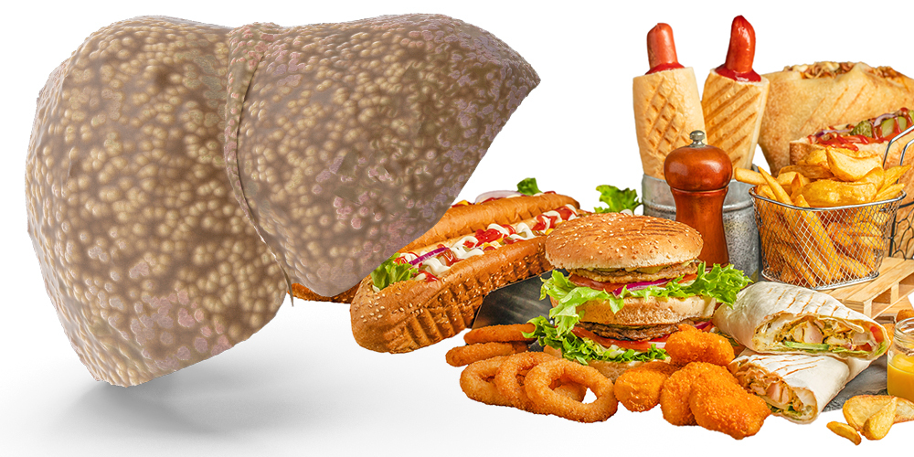 250618-UPF-liver-disease 250618-UPF-liver-disease