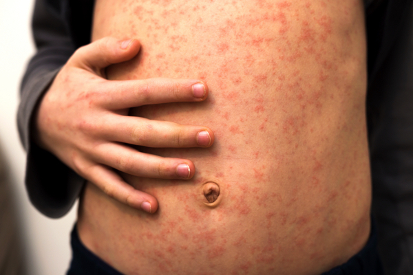stomach-with-red-rush-spots-from-measles-or-chicken-pox-1 stomach-with-red-rush-spots-from-measles-or-chicken-pox-1