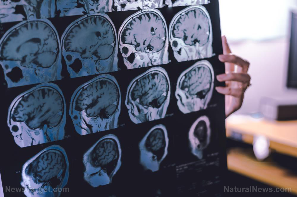 Dementia-Frontotemporal-Film-Mri-Anatomy-Atrophy-Brain Dementia-Frontotemporal-Film-Mri-Anatomy-Atrophy-Brain