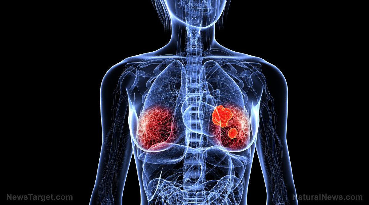 Woman-X-Ray-Breast-Cancer-3D-Image